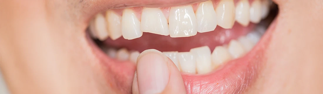 Tooth Contouring and Reshaping in Orange City FL Tooth Contouring and Reshaping in Orange City FL