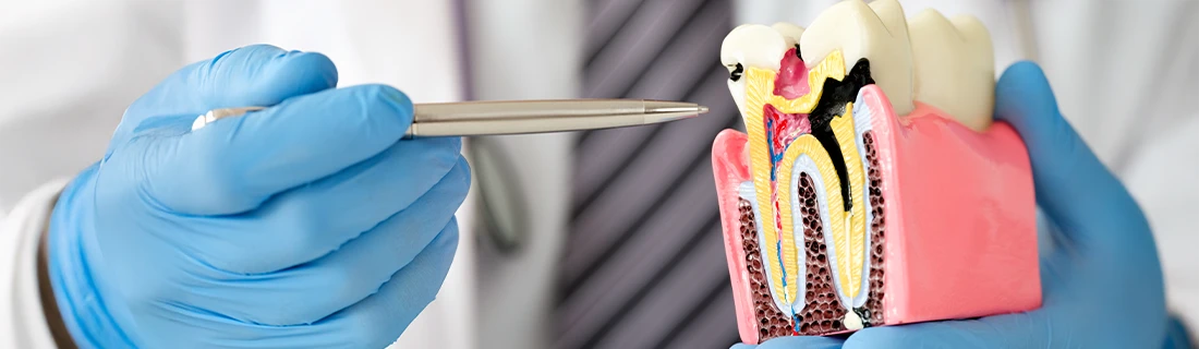 Root Canal Treatment in Orange City FL Root Canal Treatment in Orange City FL