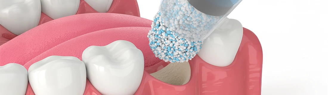 Bone Grafting in Orange City FL Bone Grafting in Orange City FL