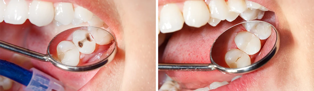 Composite Dental Fillings in Orange City FL Composite Dental Fillings in Orange City FL