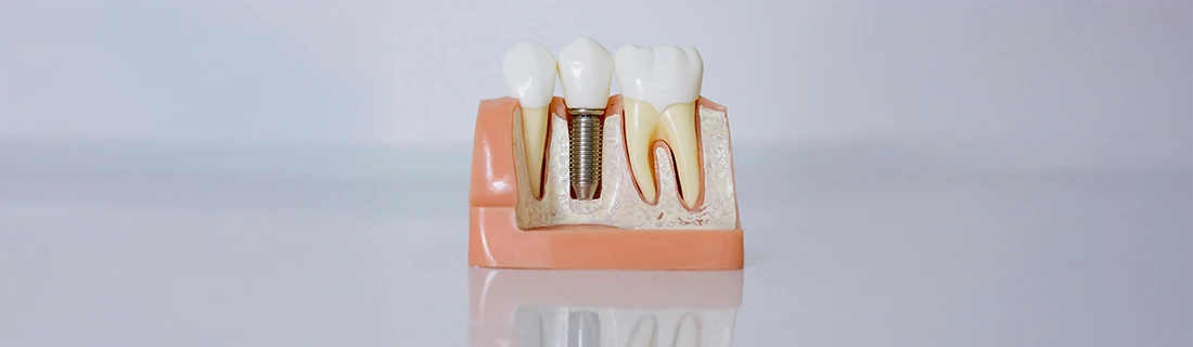 Frequently Asked Questions About Dental Implants in Orange City FL Frequently Asked Questions About Dental Implants in Orange City FL