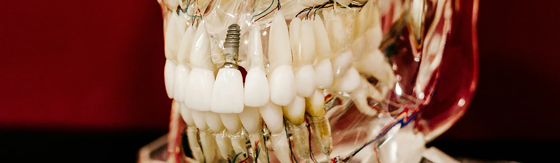 FC – Dental Implants at Premier Dentistry in Orange City, FL FC – Dental Implants at Premier Dentistry in Orange City, FL