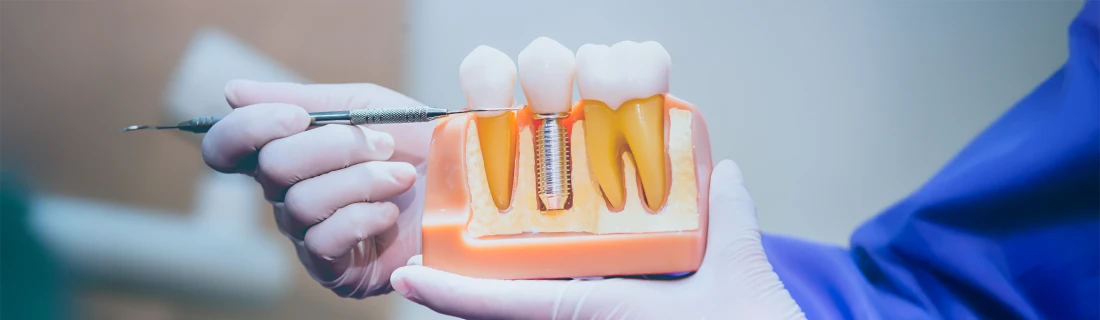 Implant Dentistry in Orange City FL Implant Dentistry in Orange City FL