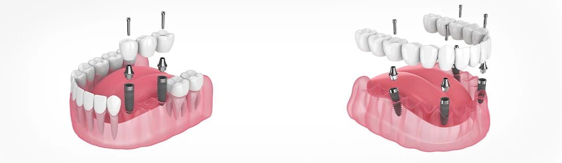 Prosthodontics in Orange City FL Prosthodontics in Orange City FL