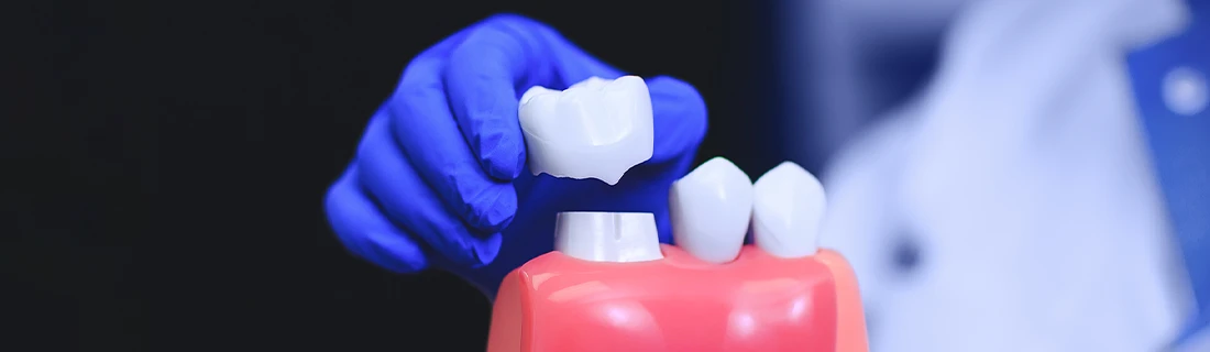 Dental Crowns in Orange City FL Dental Crowns in Orange City FL
