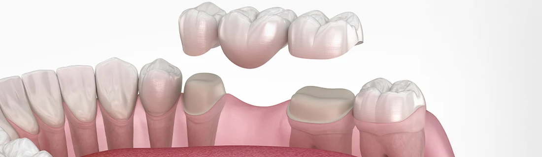 Dental Bridges in Orange City FL Dental Bridges in Orange City FL
